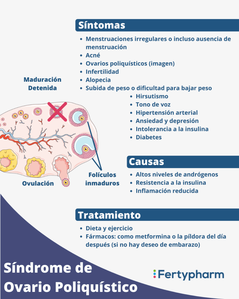 que es el sindrome de ovario poliquistico